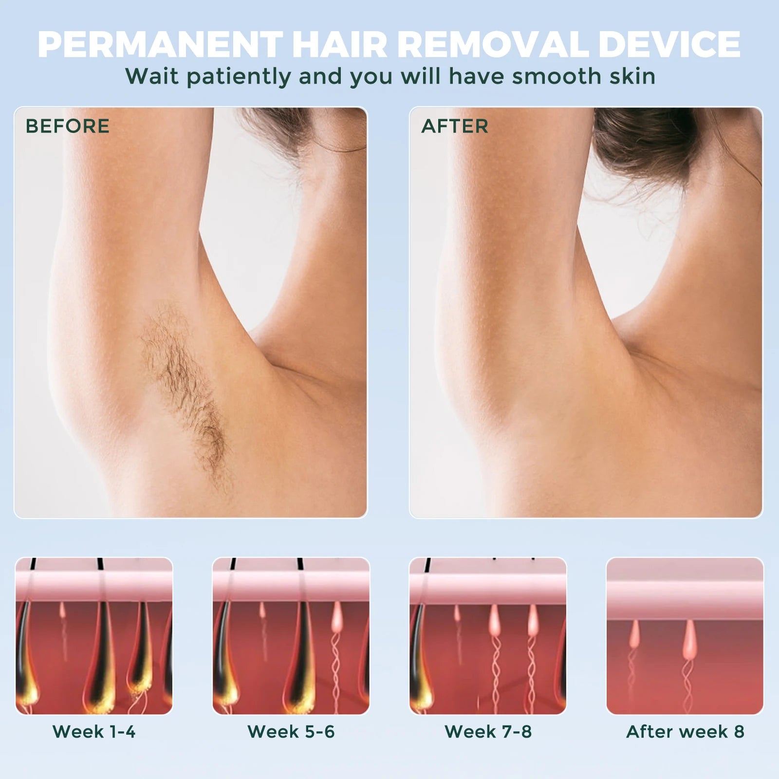 Sejoy Portable IPL Laser Epilator 5 Modes - Painless, Permanent Hair Removal for Women’s Full Body,Bikini,Leg, Face,Underarm